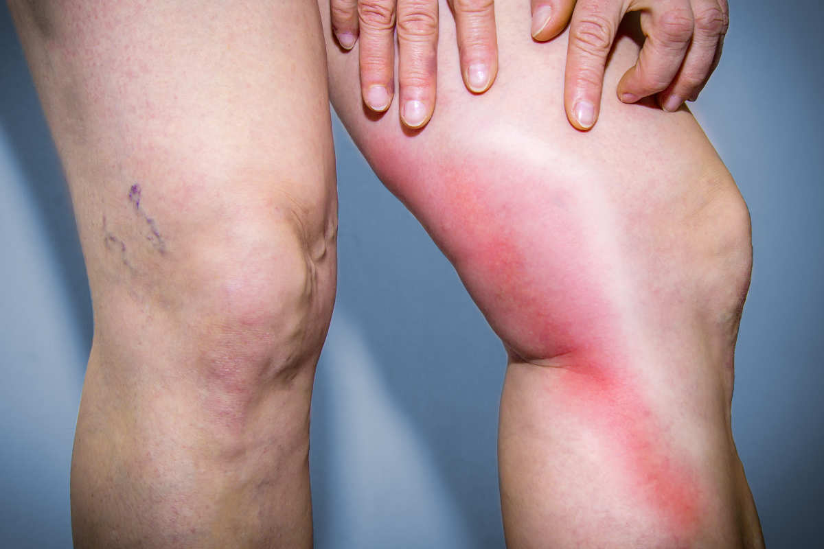 5 rimedi infallibili per le gambe gonfie e pesanti